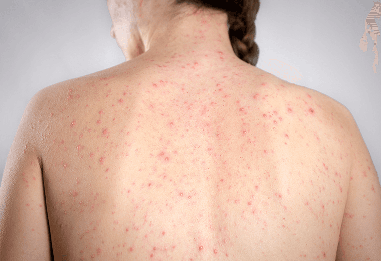 Ministerio de Salud confirma segundo caso de sarampión en Costa Rica