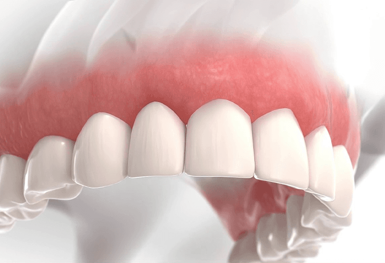 Carillas dentales: cómo mantenerlas sanas y duraderas