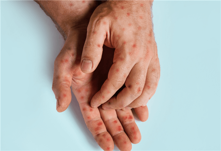 Salud suspende clases en Liceo de Moravia mientras investiga nuevo caso de sarampión