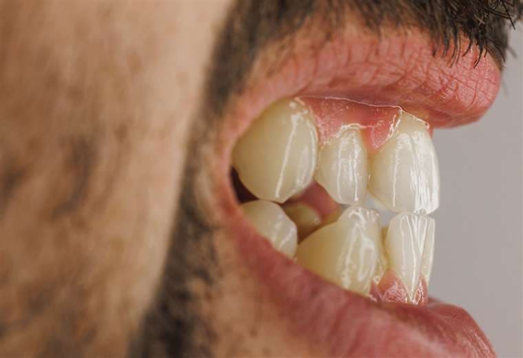 Casi todos la tienen y pocos lo saben: la gingivitis enciende las alarmas